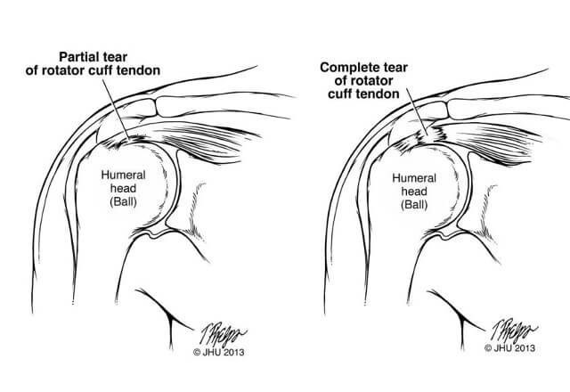 Sub-Acromial Shoulder Impingement Explained