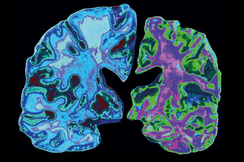 Article and Comment: We may finally know what causes Alzheimer’s – and how to stop it