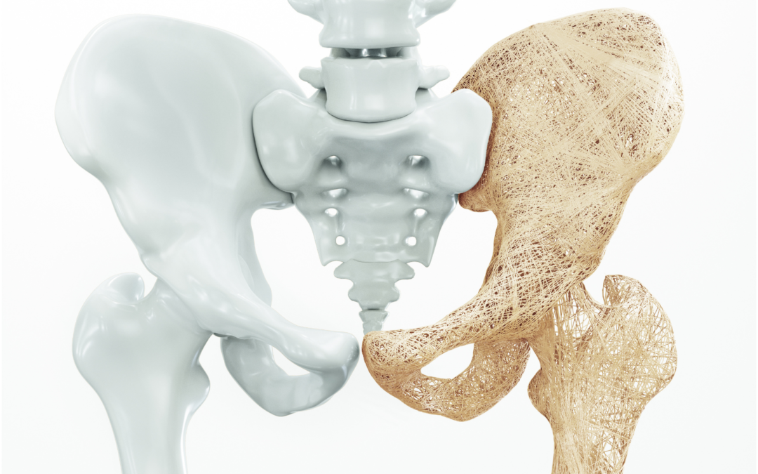 Osteoporosis-Prevention and Management