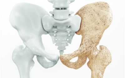 Understanding Osteoporosis: Your guide to stronger bones