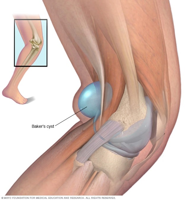 bakers cyst