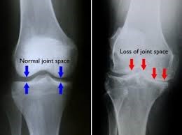 Knee osteoarthritis Xray