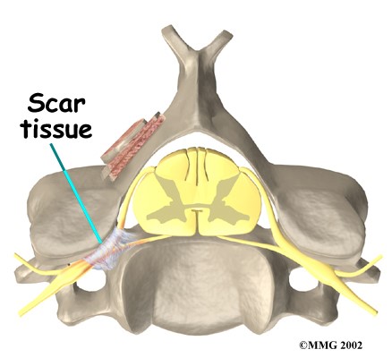 ScarTissue Cervical Spine