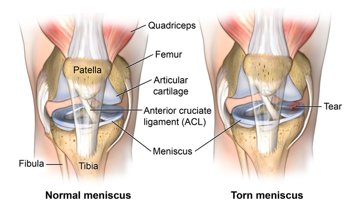 Knee Meniscus Front view