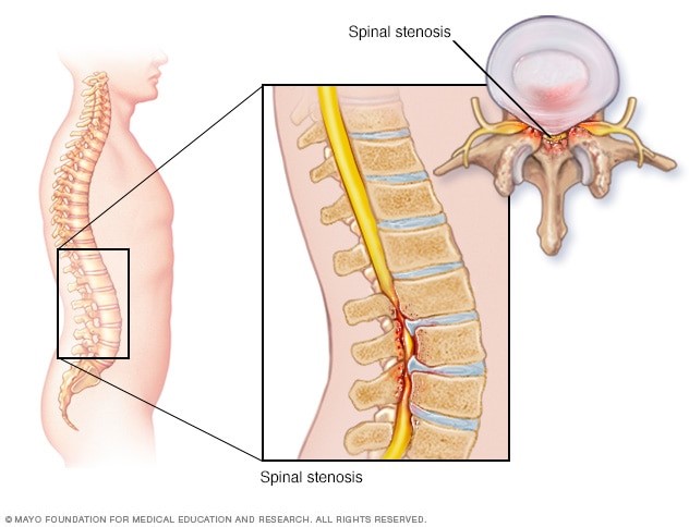 lumbar canal stenosis