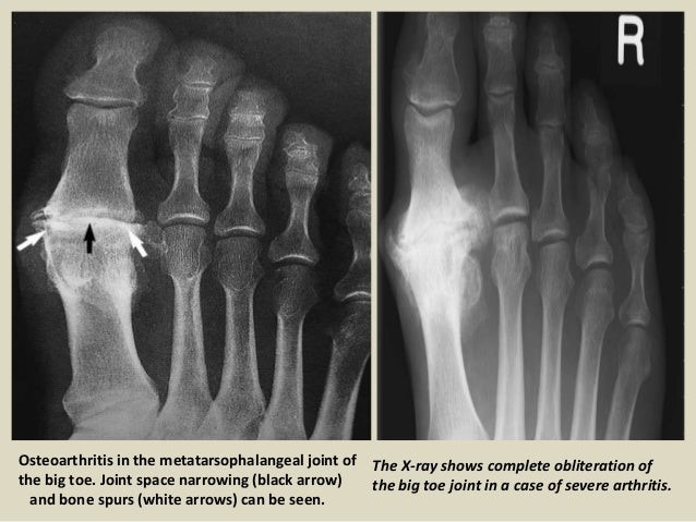 Ankle impingement