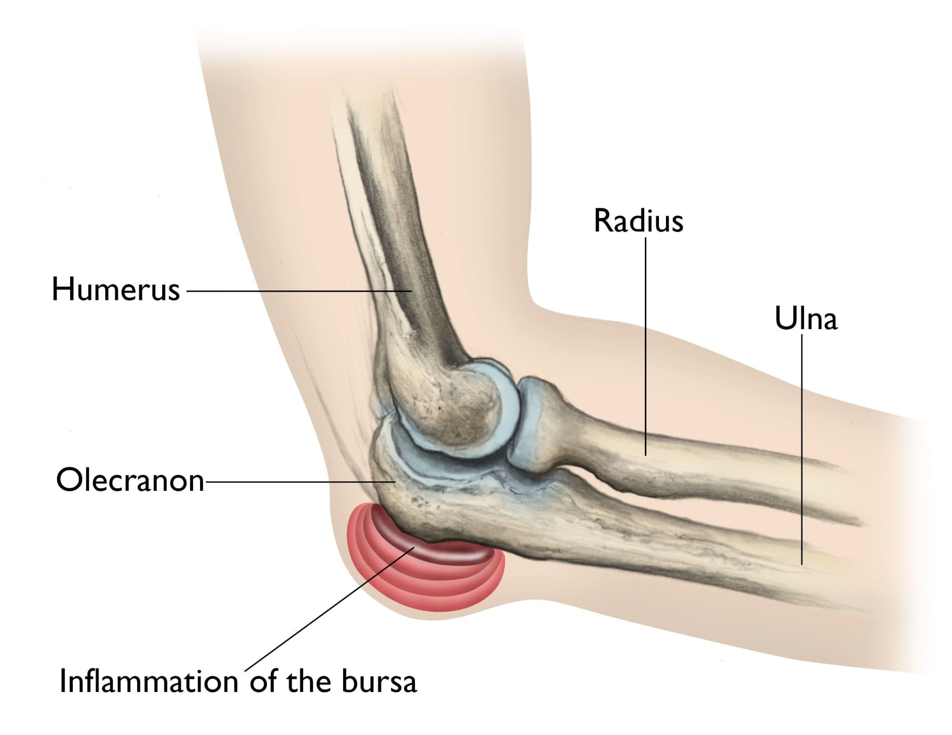 AC joint injury