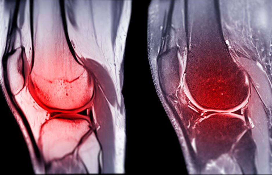 ACL – Reconstruction or Non-surgical